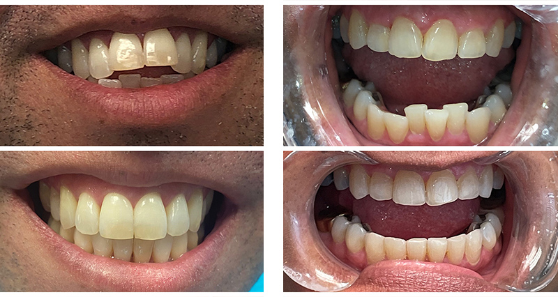 Invisalign in Brentwood