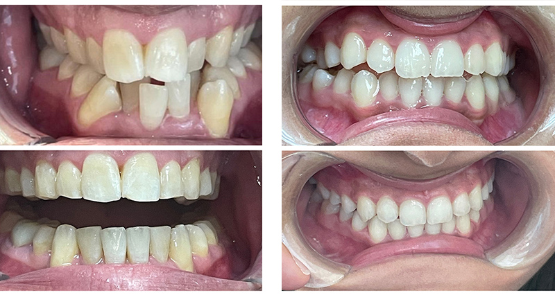 Invisalign in Brentwood